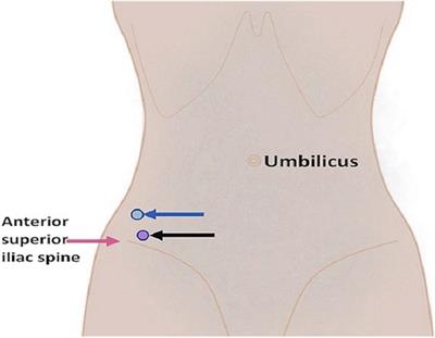 Ultrasound-Guided Percutaneous Drainage of Iliopsoas Abscess With Septicemia in an Adolescent: A Case Report and Literature Review